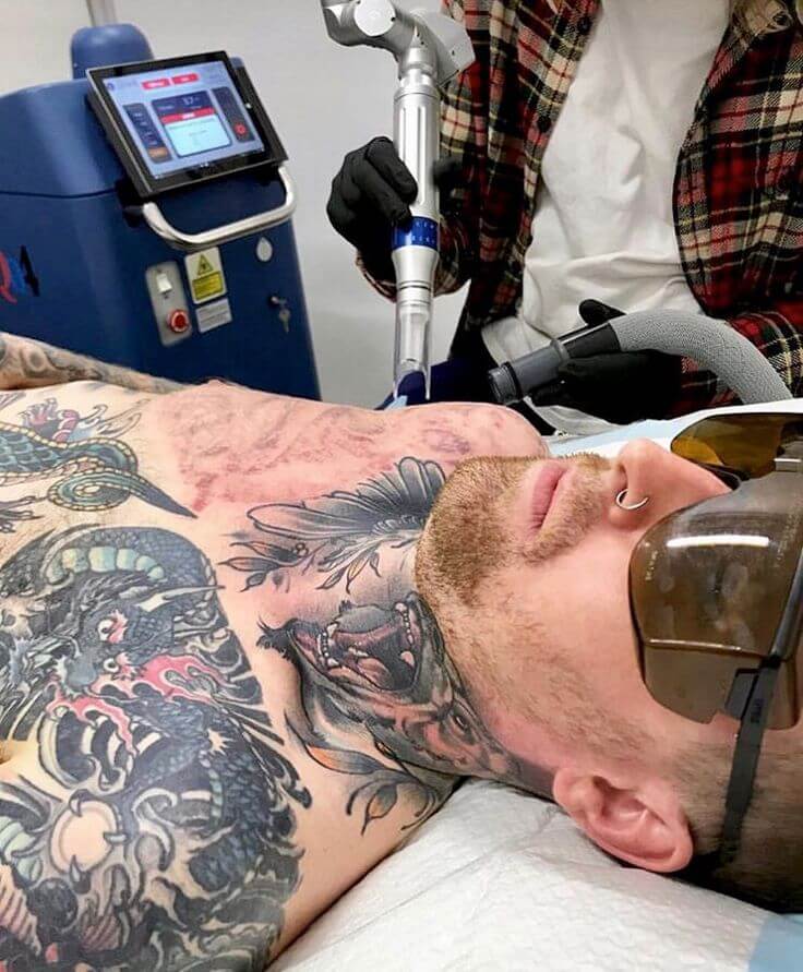 Tattoo Removal Considerations